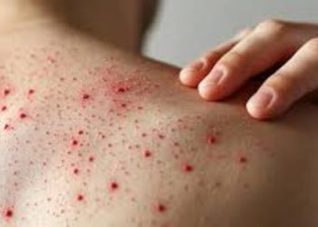 México y la OPS activan plan de emergencia contra sarampión