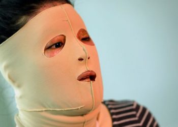 Desfiguradas por machismo, olvidadas por la justicia: Más de 3 mil mujeres agredidas con sustancias corrosivas