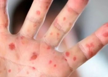 Suben a 12 los muertos por sarampión en México; Chihuahua concentra mayoría de casos