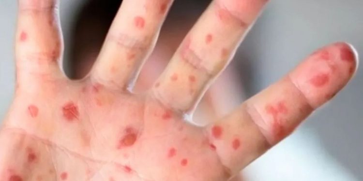 Suben a 12 los muertos por sarampión en México; Chihuahua concentra mayoría de casos