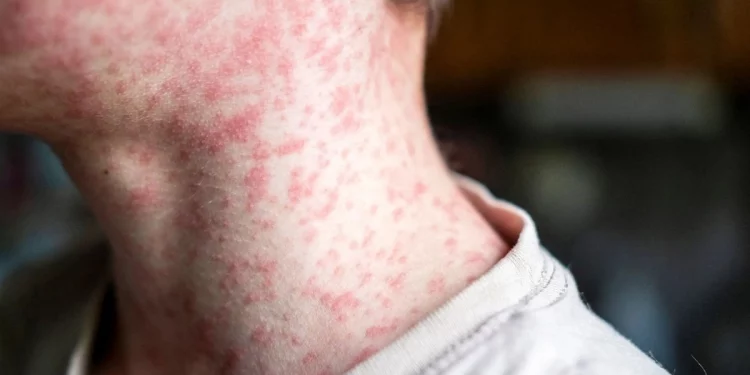 Anuncia Sheinbaum plan para ampliar vacunación contra el sarampión